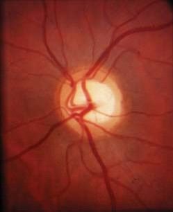 Glaucoma diagnosis and management at MEDICS Eye Centre